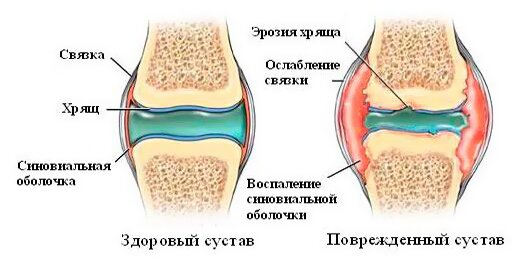 Здоровый и поврежденный сустав