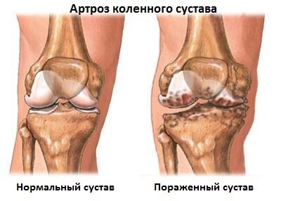 Артроз коленного сустава